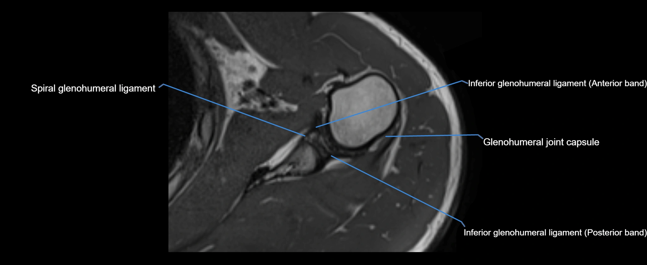 shoulder ligaments axial 3d 3t mri image-img-00005-00083.webp